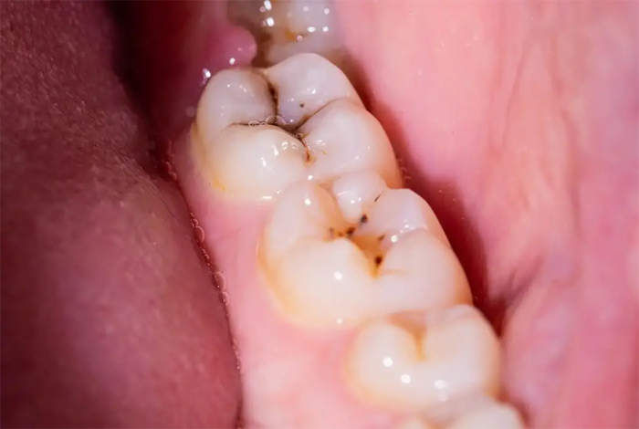 Зубные полости, жевательные зубы