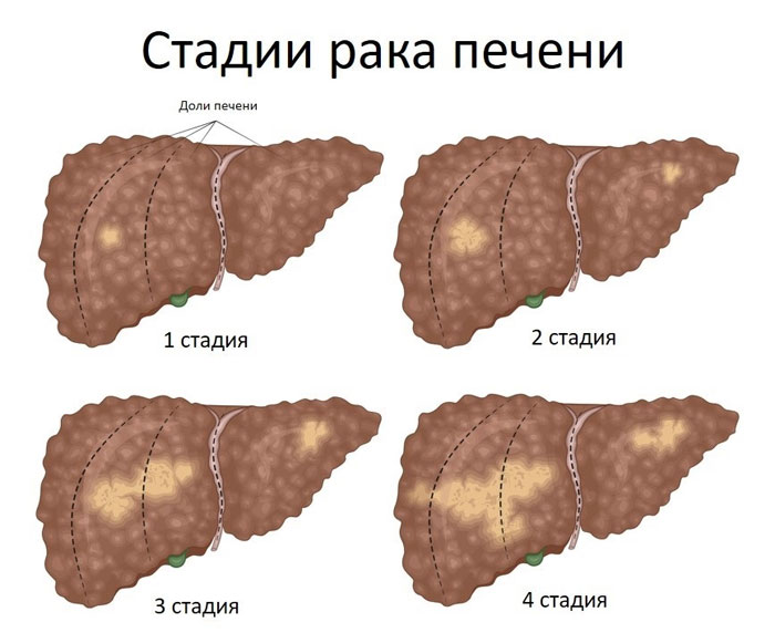 Понимание карциномы печени: ключевые аспекты и лечение